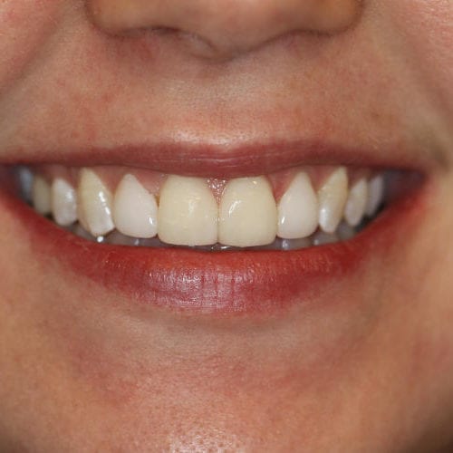 after cosmetic dentistry results by Paul F. Bowersox, DDS