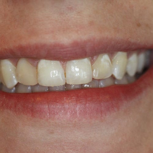 before cosmetic dentistry results by Paul F. Bowersox, DDS