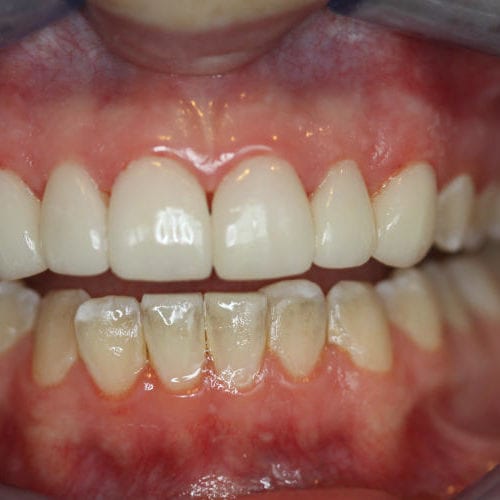 after cosmetic dentistry results by Paul F. Bowersox, DDS