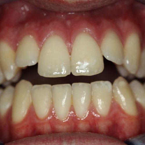 before cosmetic dentistry results by Paul F. Bowersox, DDS
