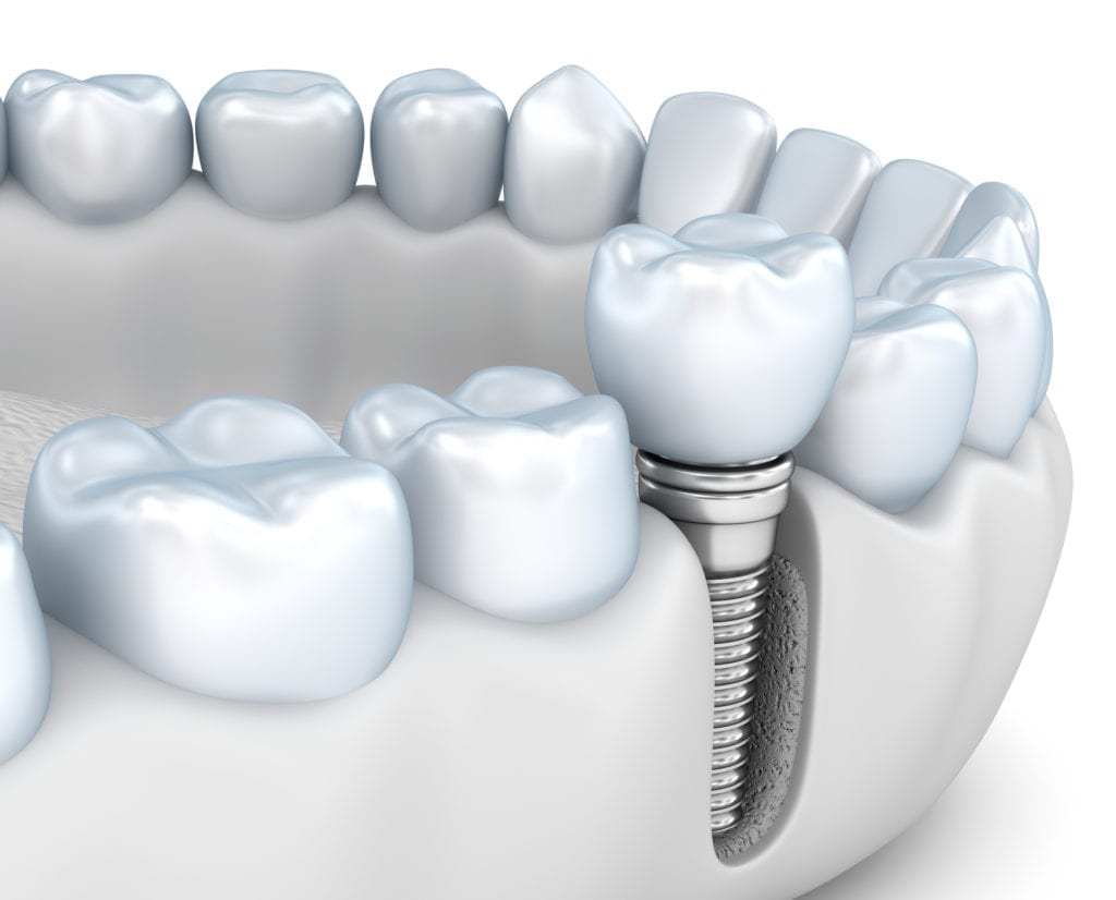 dental implants in Westminster MD
