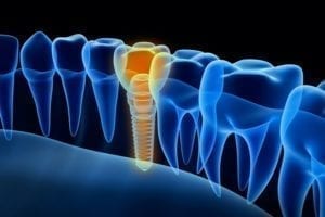 westminster, maryland dental implants
