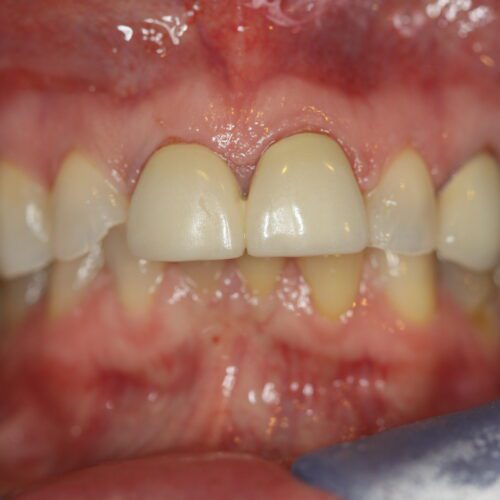 before cosmetic dentistry results by Paul F. Bowersox, DDS